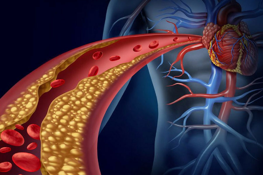 Grafico aterosclerosis 02